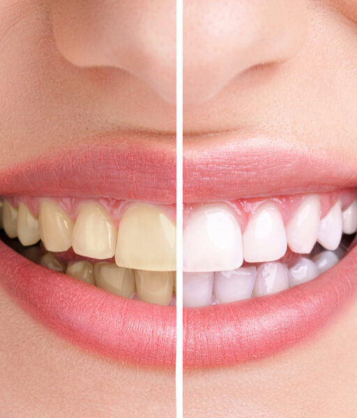 teeth-whitening